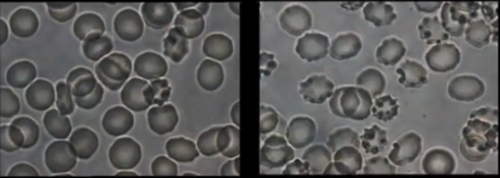 protect from graphene oxide EMF blood samples How to Detox Graphene Oxide